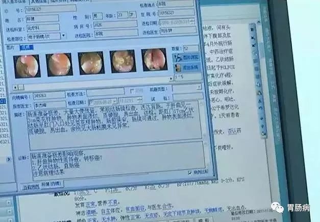 直肠癌晚期补硒