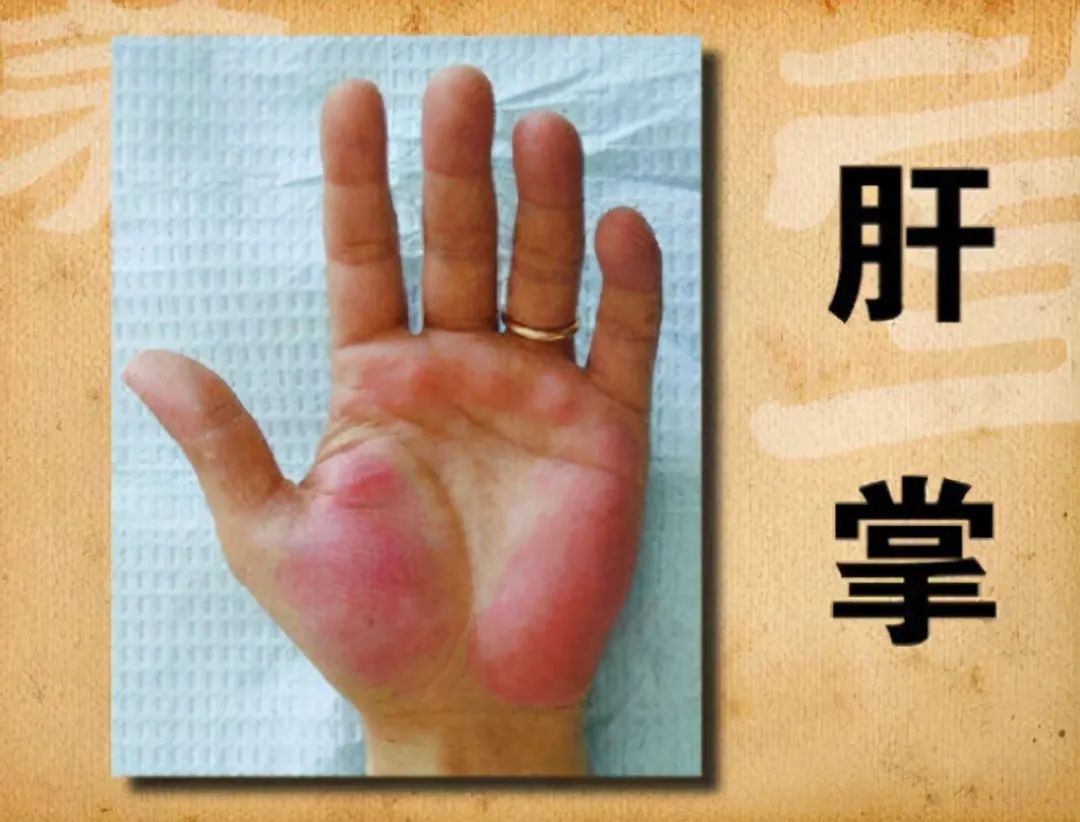补硒对肝掌有用