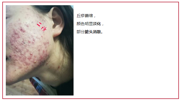 补硒治愈银屑病