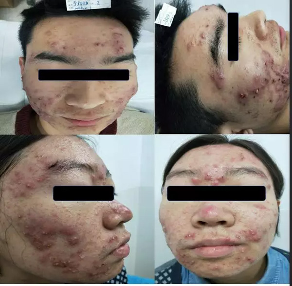 补硒治愈银屑病