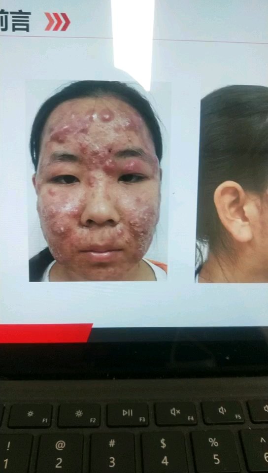 补硒治愈银屑病