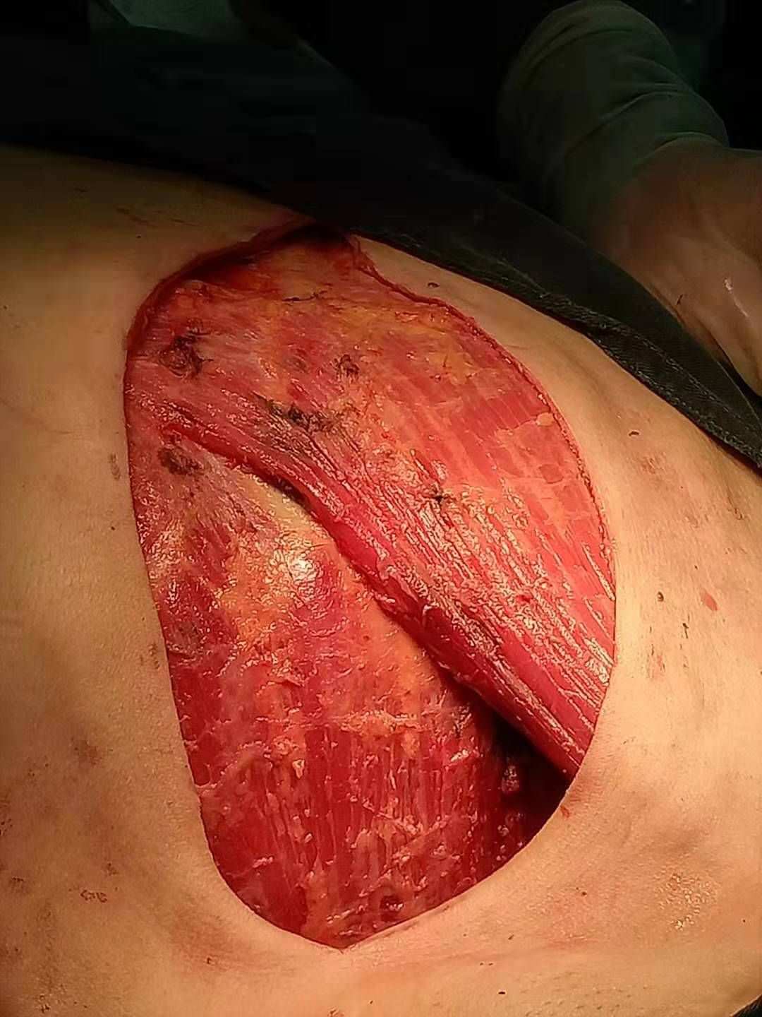 乳腺癌手术补硒