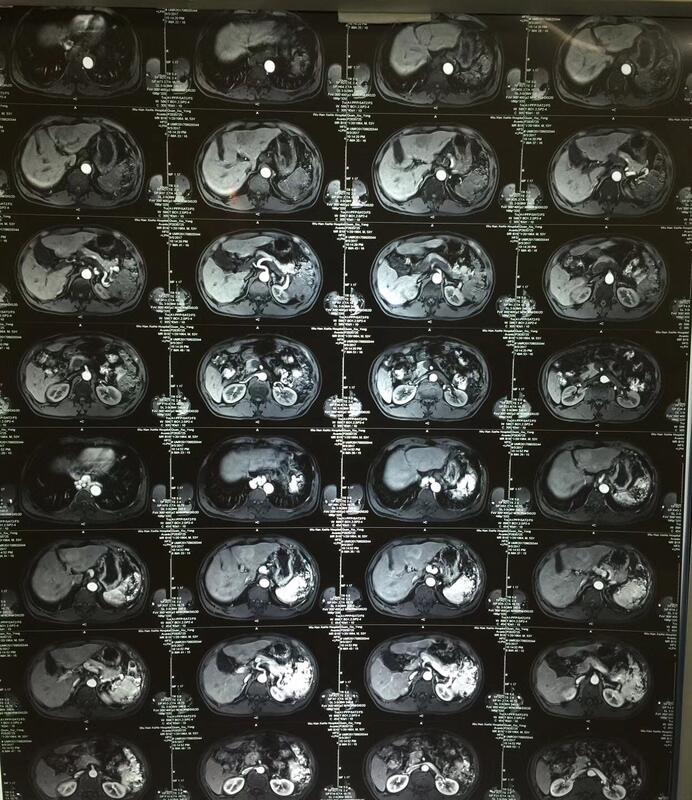 甲胎蛋白高补硒