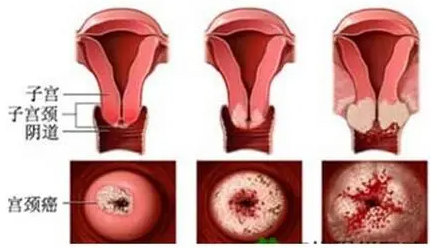 宫颈癌如何补硒