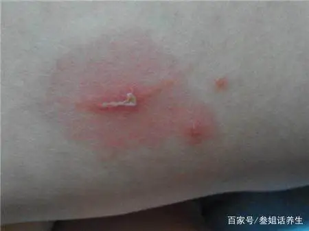 肝中毒能补硒吗