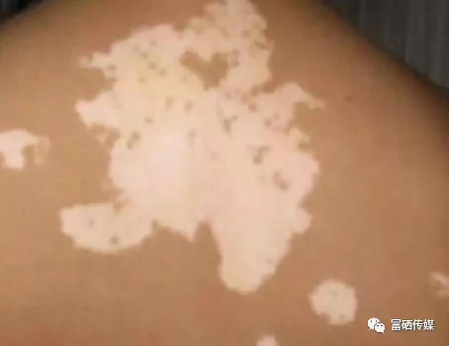 糖尿病人能补硒