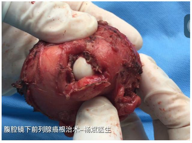 补硒与前列腺癌