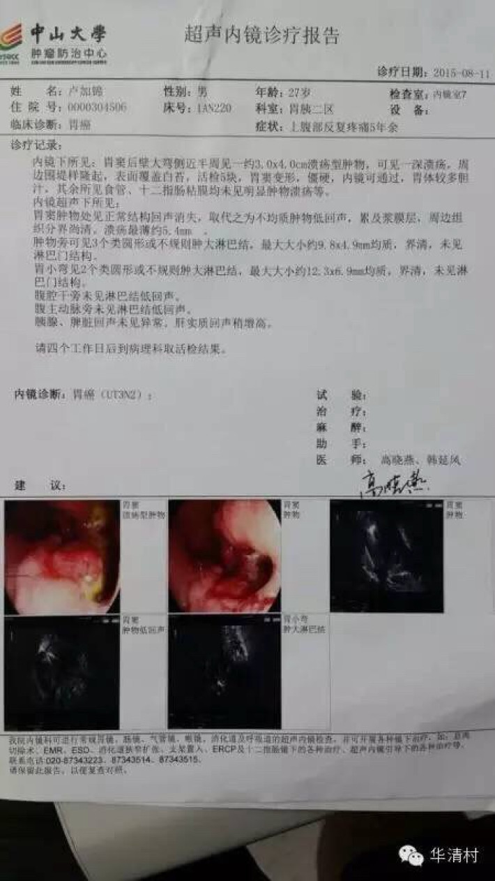 硒维康治疗胃癌