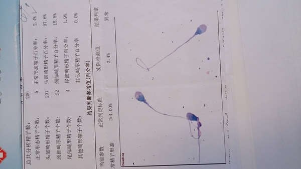 锌硒宝精子畸形