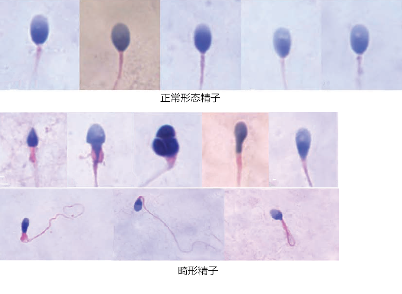 锌硒宝精子畸形
