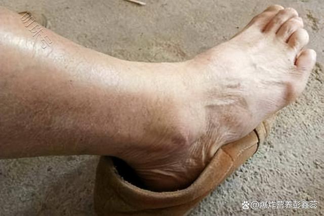 高尿酸补哪种硒
