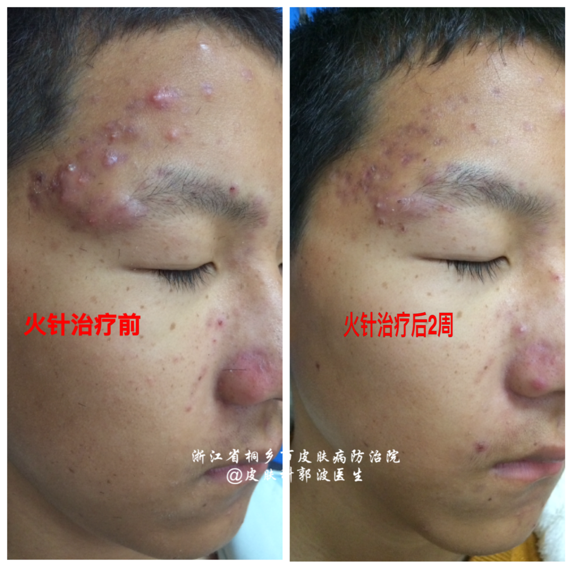 锌硒宝治疗长痘