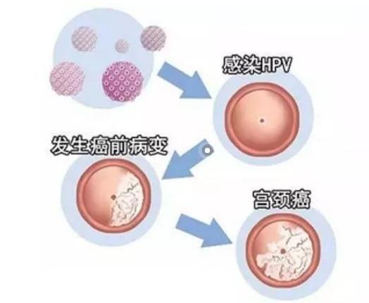 HPV阳性严不严重？感染者自己说了算，善用一个阳性转阴的办法