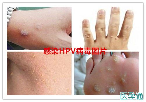 hpv高危阳补硒
