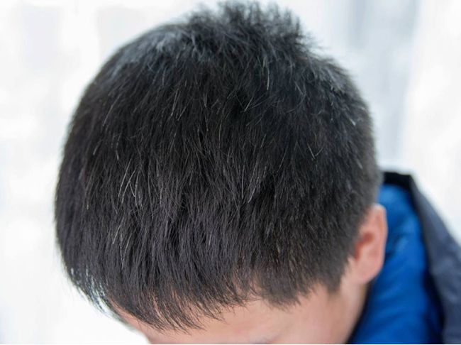 白癜风病人要补硒