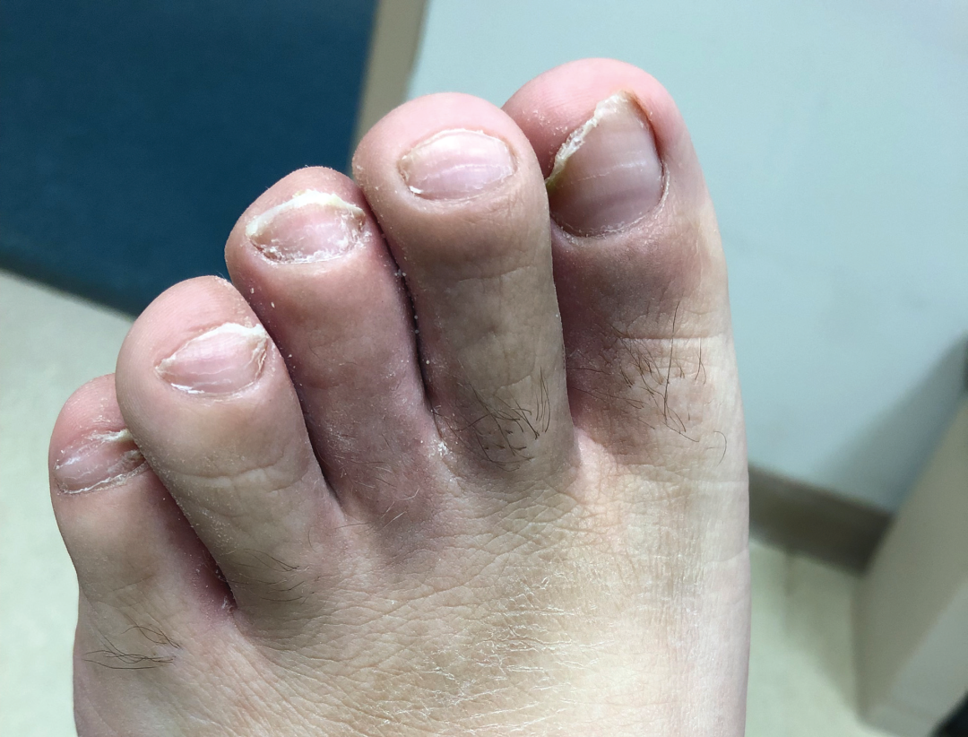 补硒 甲营养不良