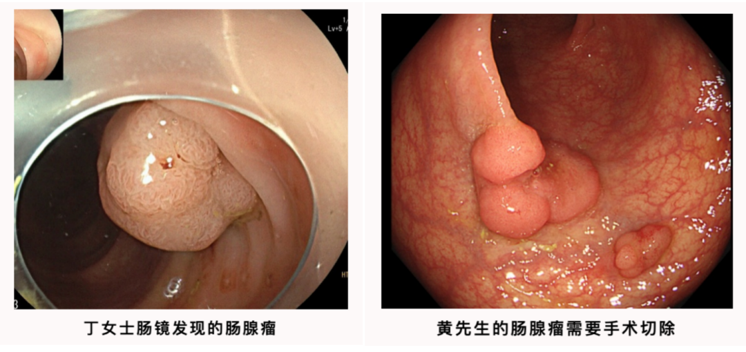 补硒能预防息肉吗