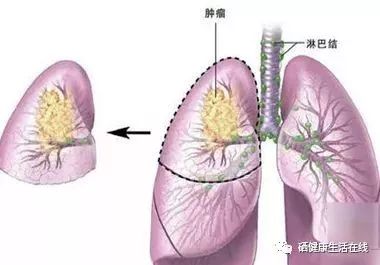 肺癌病人怎么补硒