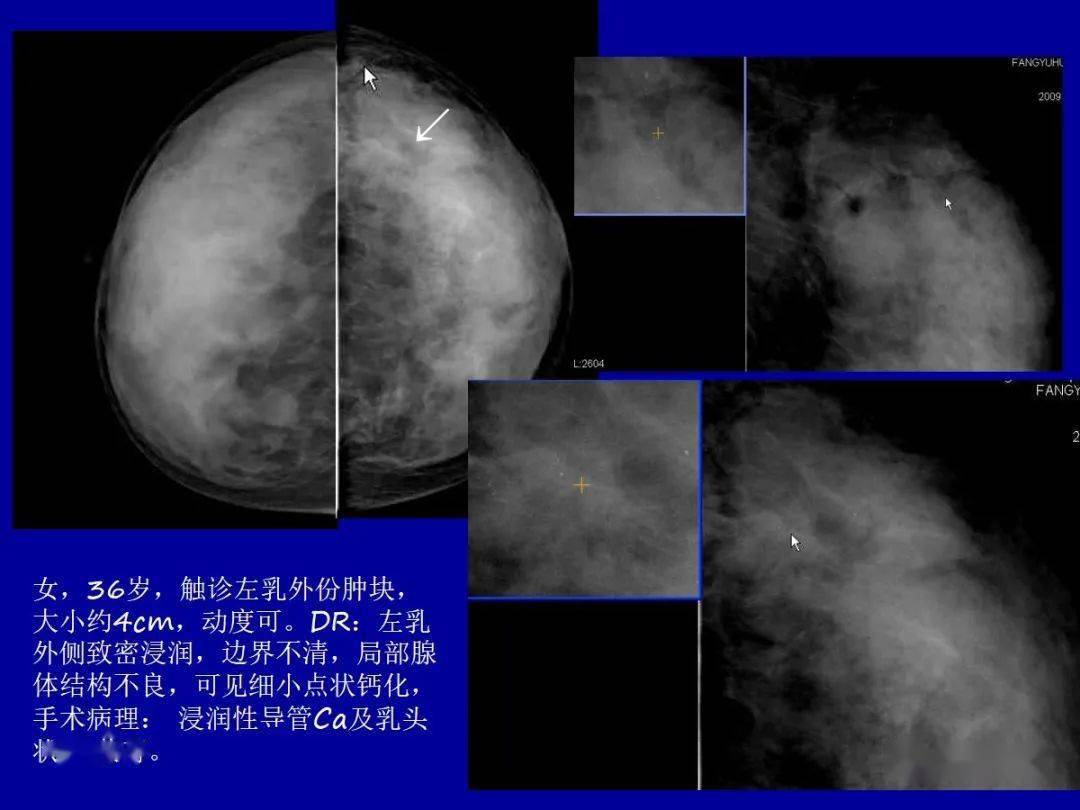 乳腺癌补什么硒好