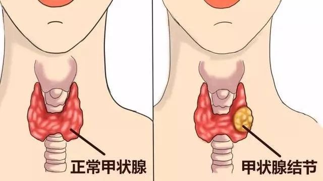 甲亢能补硒和镁吗
