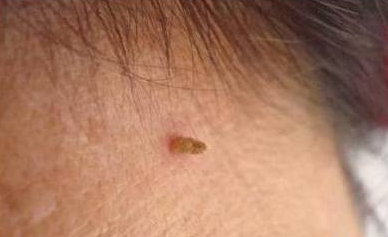 丝状疣补硒有用吗