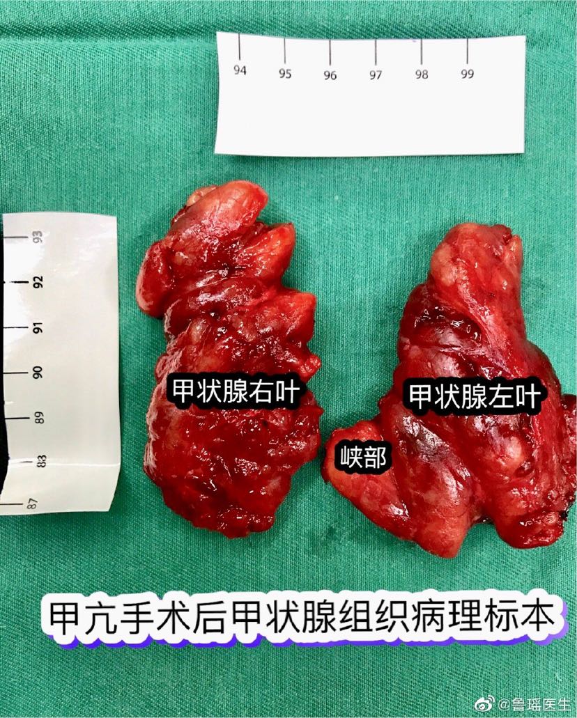甲癌术后能补硒吗