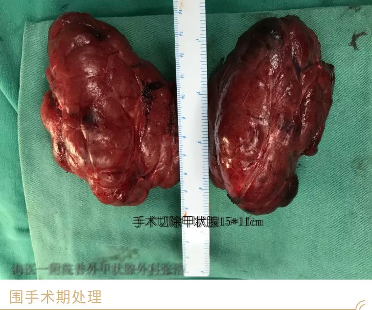 甲癌术后能补硒吗