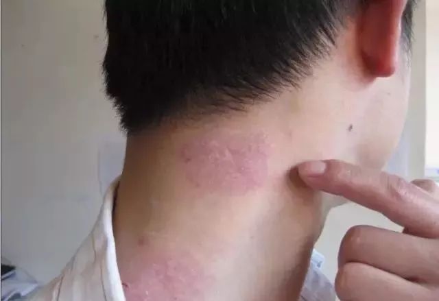 银屑病患者补硒吗