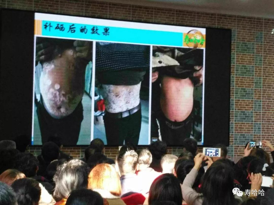 银屑病患者补硒吗