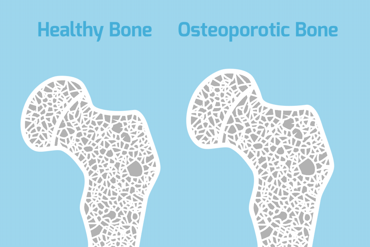 骨质疏松怎么补钙