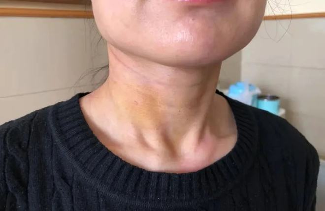 甲状腺结节硒维康