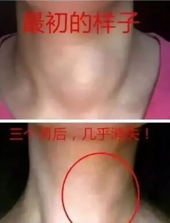 甲状腺结节硒维康
