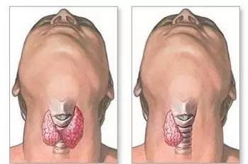 甲状腺结节硒维康