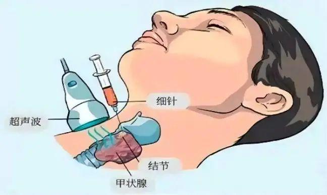 甲状腺结节硒维康