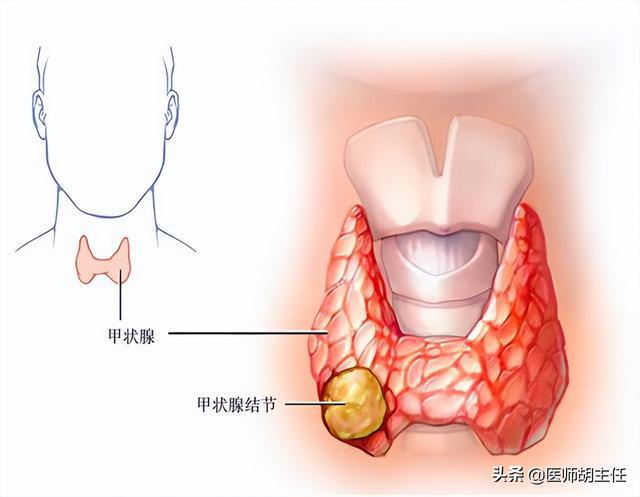 甲状腺结节硒维康