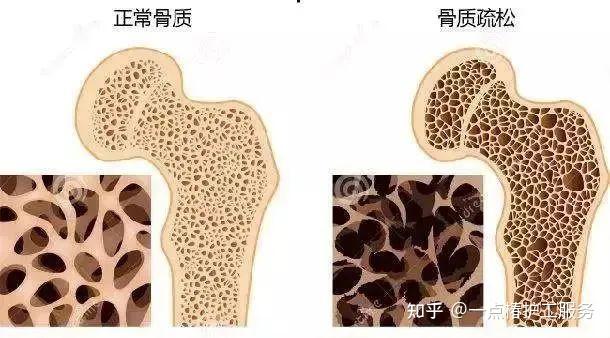 骨质疏松补钙有用吗