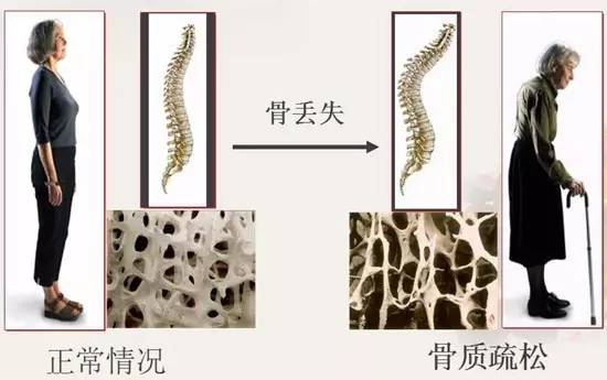 更年期如何补钙
