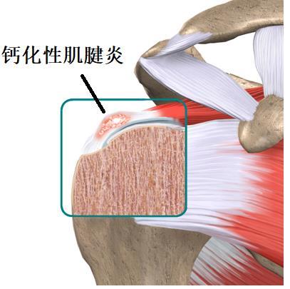 甲状腺手术后为什么要补钙