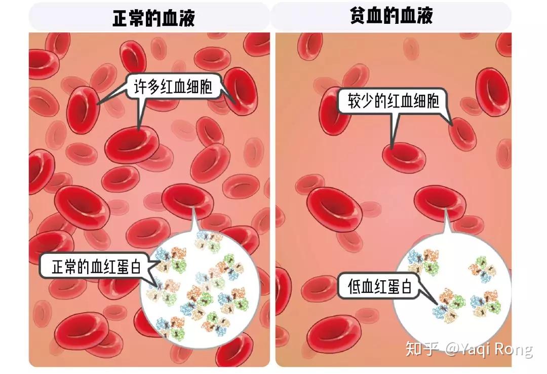 地贫不能补铁