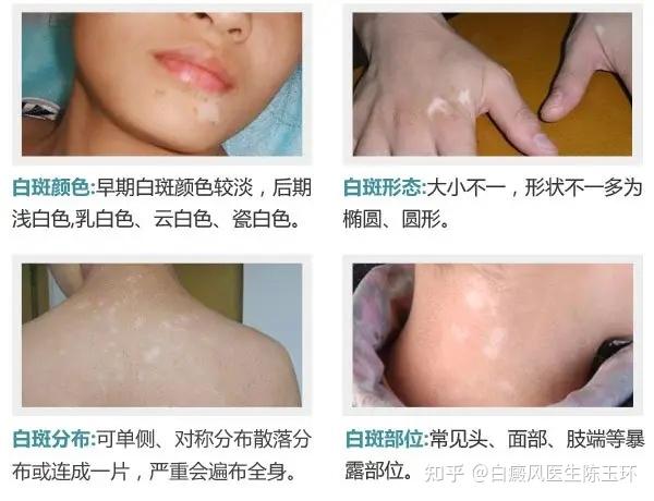白癜风补硒效果好吗