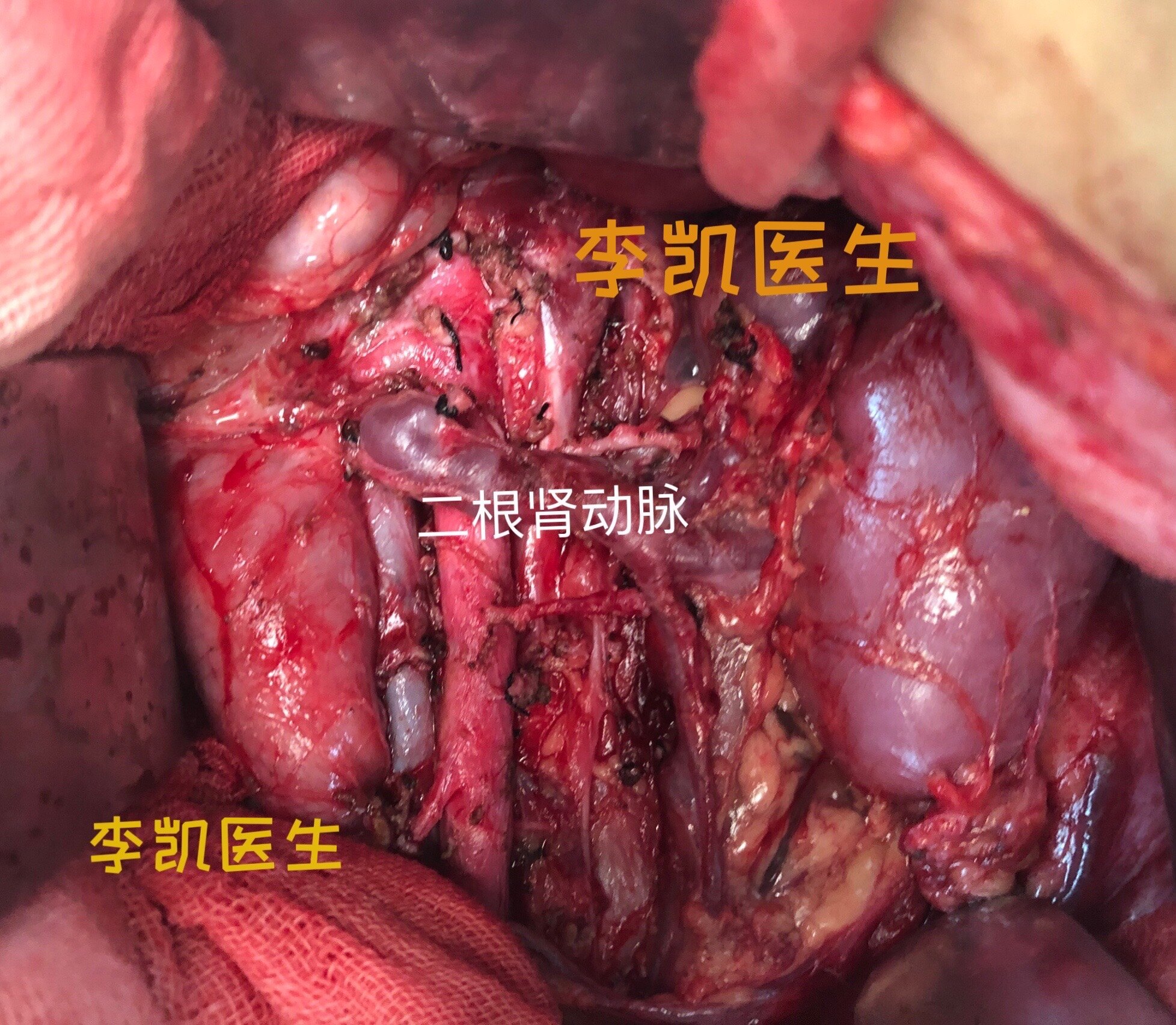 iga肾病能补硒吗