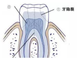 补钙对牙齿有好处吗
