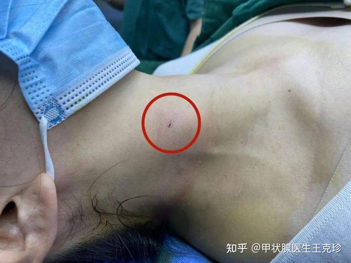 甲状腺结节能补硒嘛