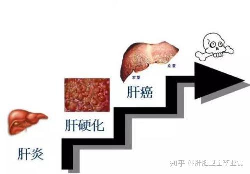 乙肝肝硬化患者补硒