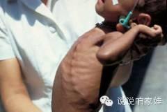 宝宝补钙多了有什么坏处