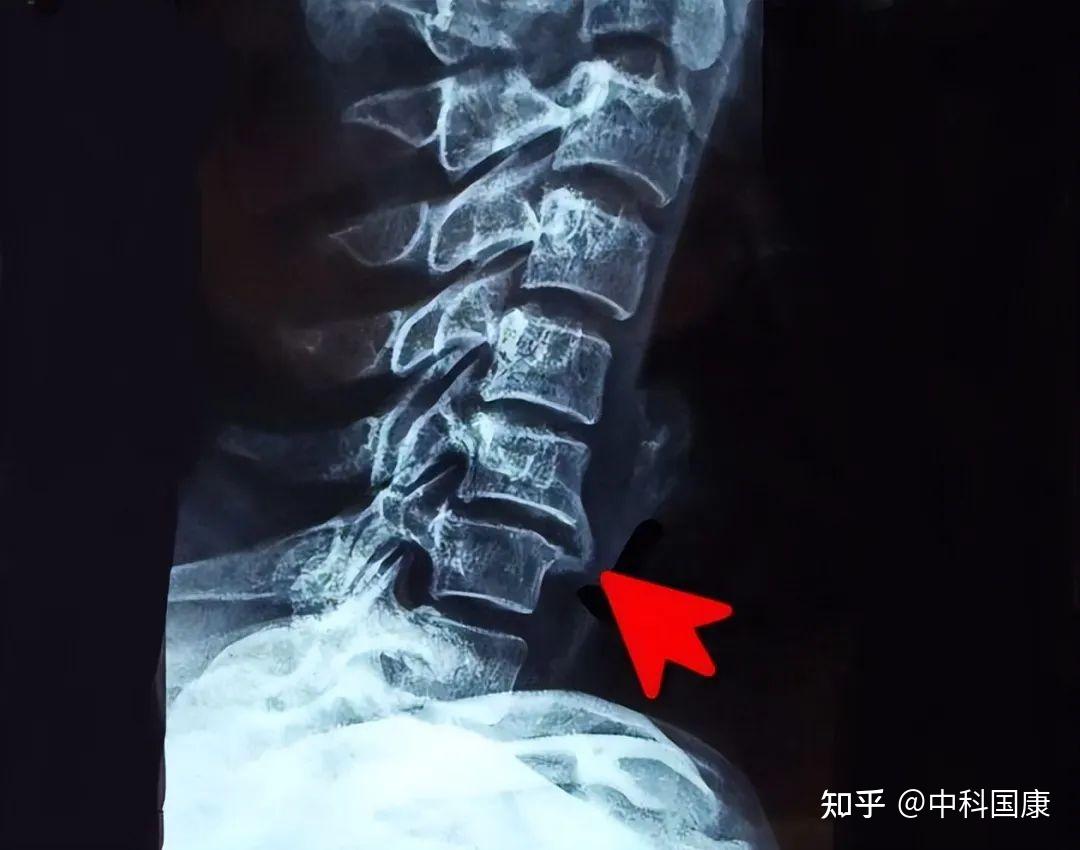 骨质增生能补钙吗