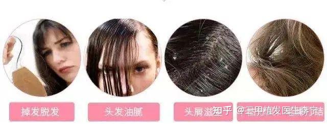 掉头发缺什么微量元素