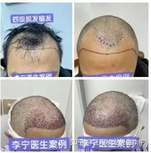 掉头发缺什么微量元素