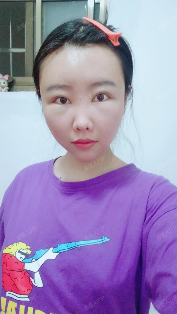 近视缺乏什么微量元素
