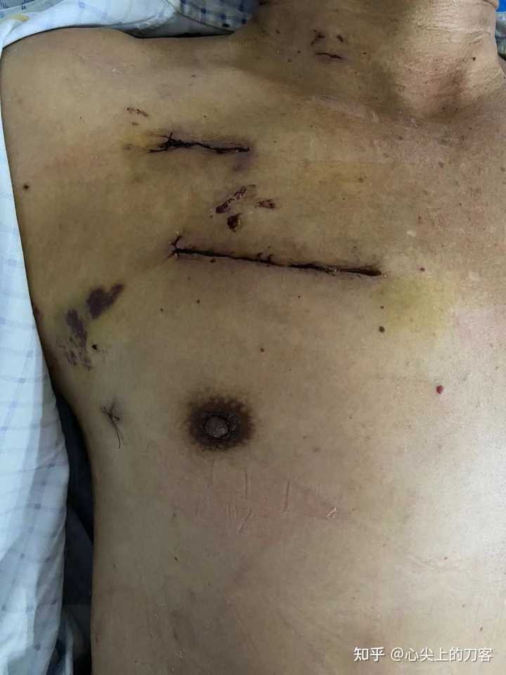 心脏搭桥可以补硒吗